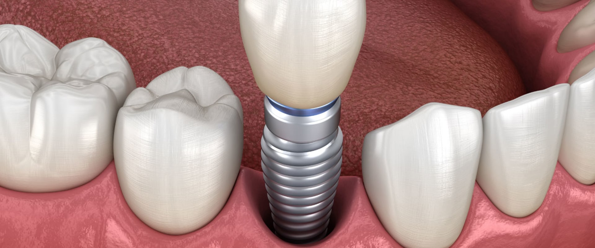 The Pros and Cons of Dental Implants: A Comprehensive Guide