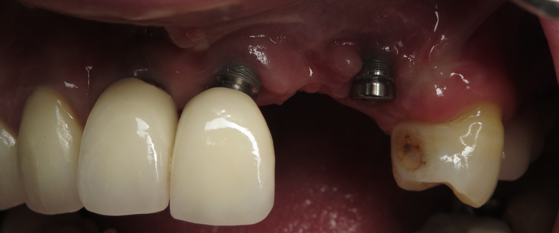 Can I Go Back to Work After a Dental Implant Procedure?