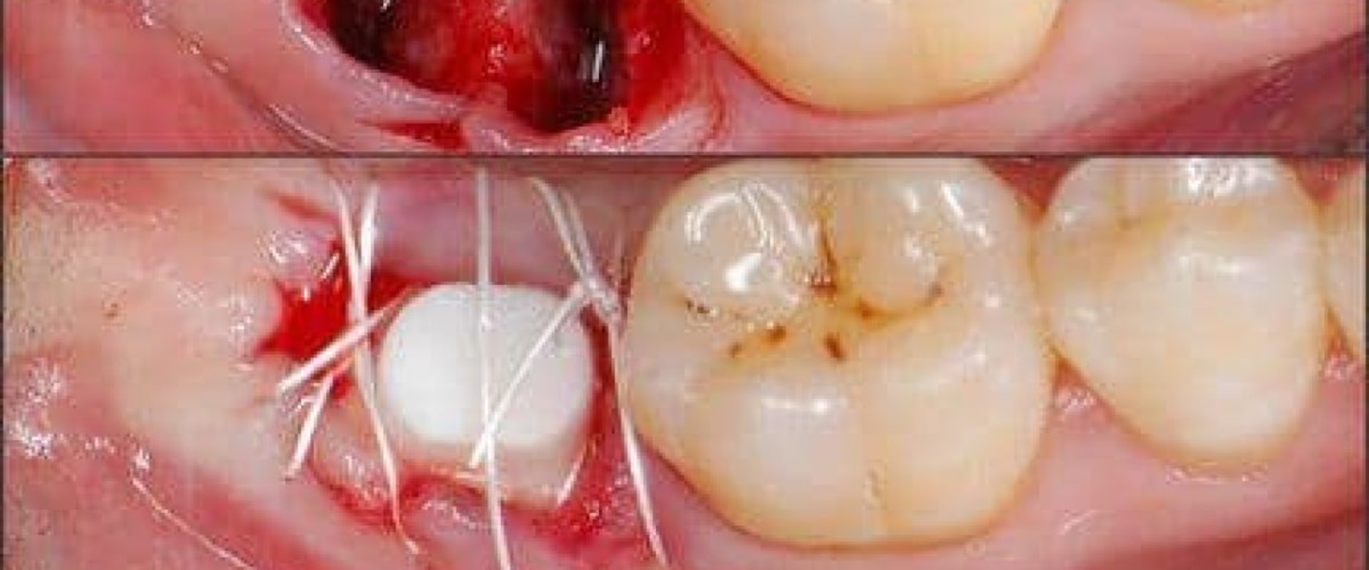 How Long Does it Take for Gums to Heal After Implant Surgery?