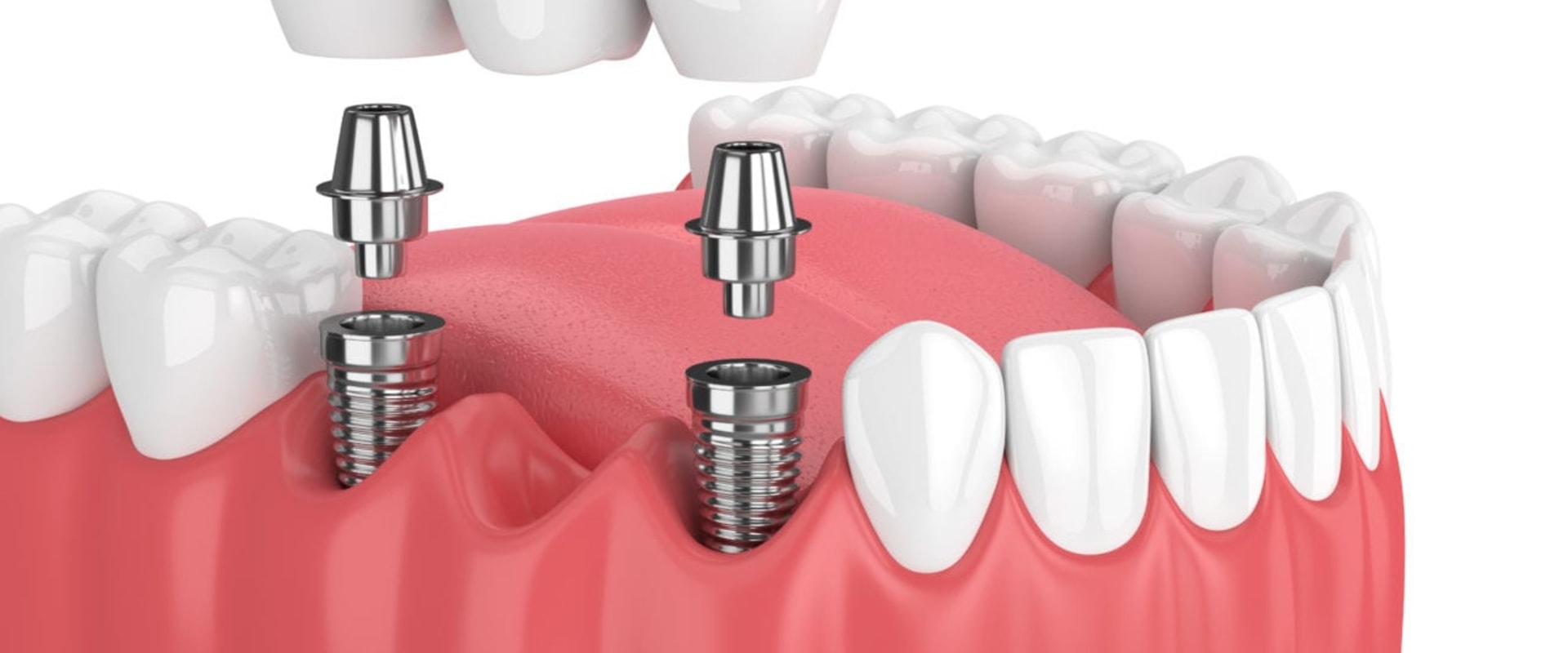 Getting a Dental Implant: A Comprehensive Step-by-Step Guide