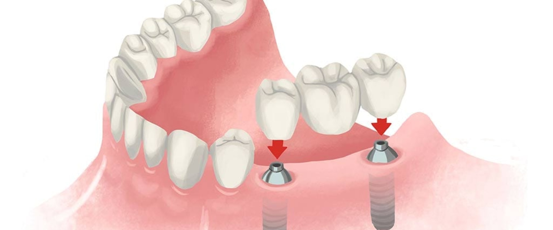 How Often Should You Get Your Dental Implants Checked? A Guide for Patients