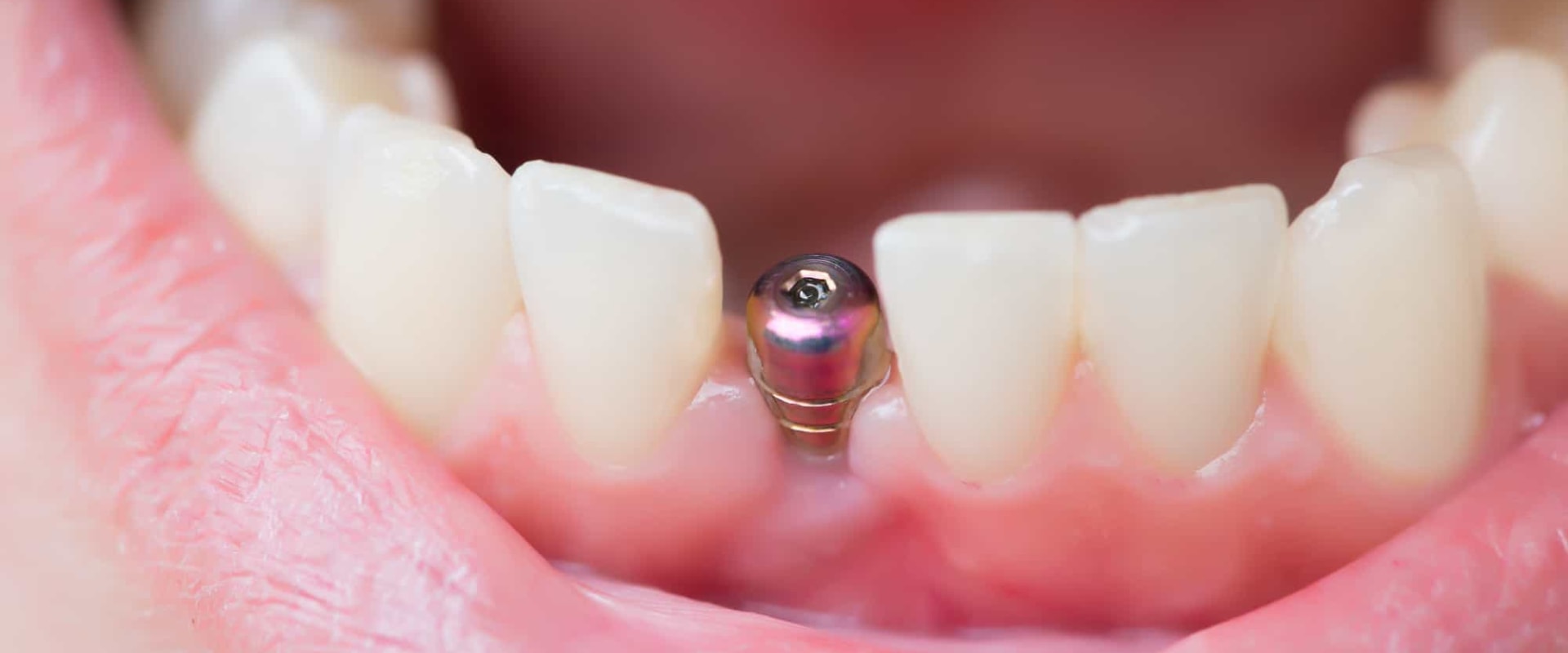 What's the Next Step After a Dental Implant is Placed? - A Comprehensive Guide