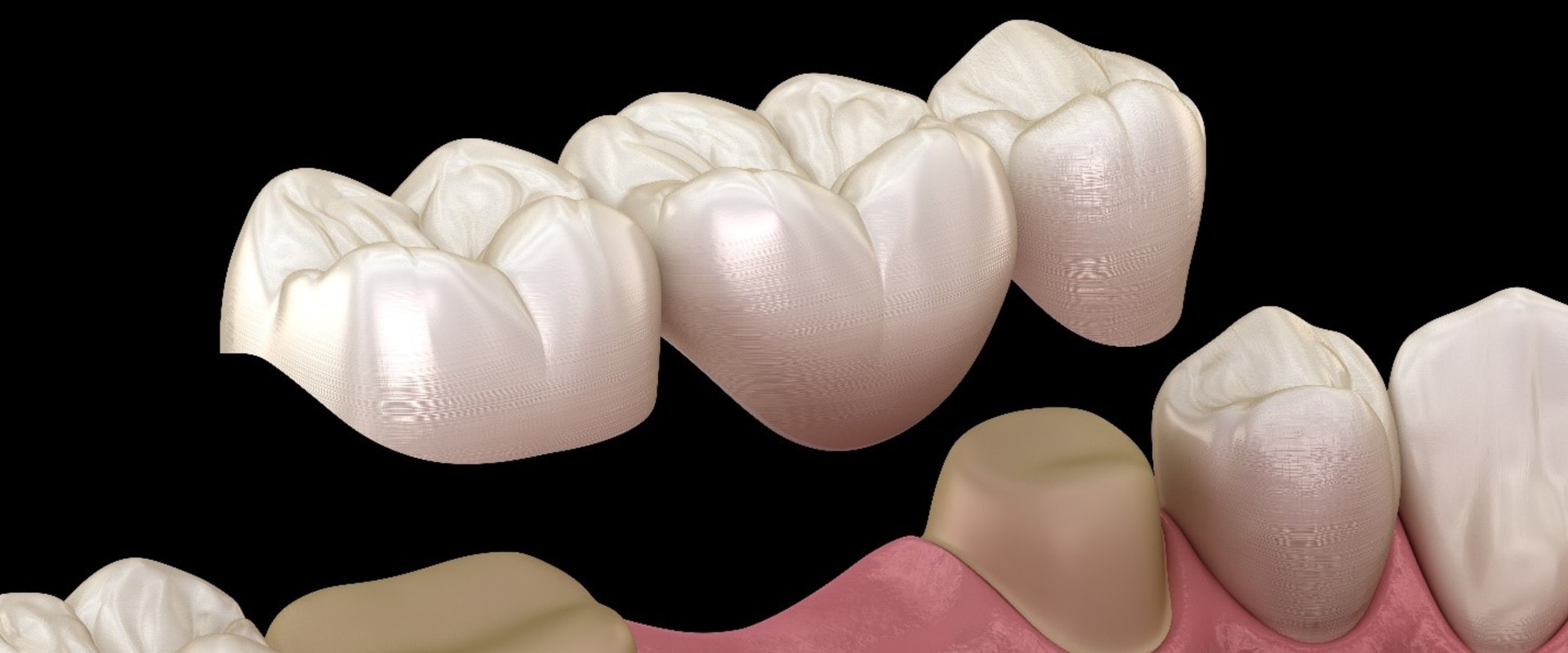 The Pros and Cons of Dental Bridges: A Comprehensive Guide