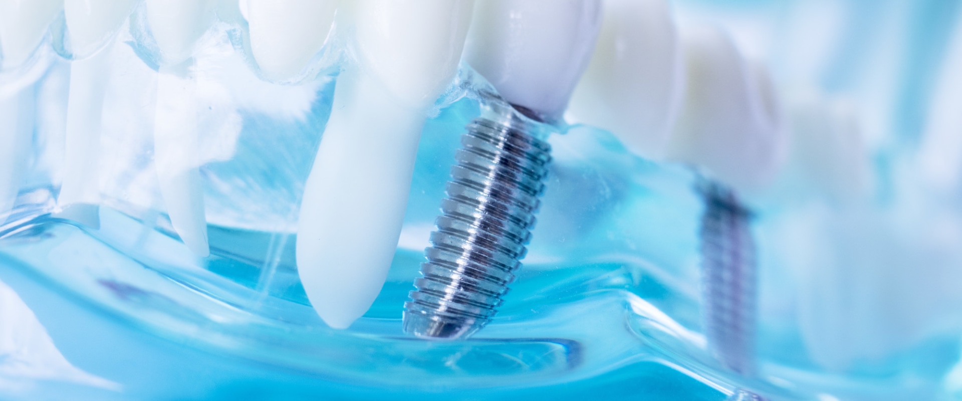 Caring for Teeth with Dental Implants: Special Cleaning Techniques for Optimal Results