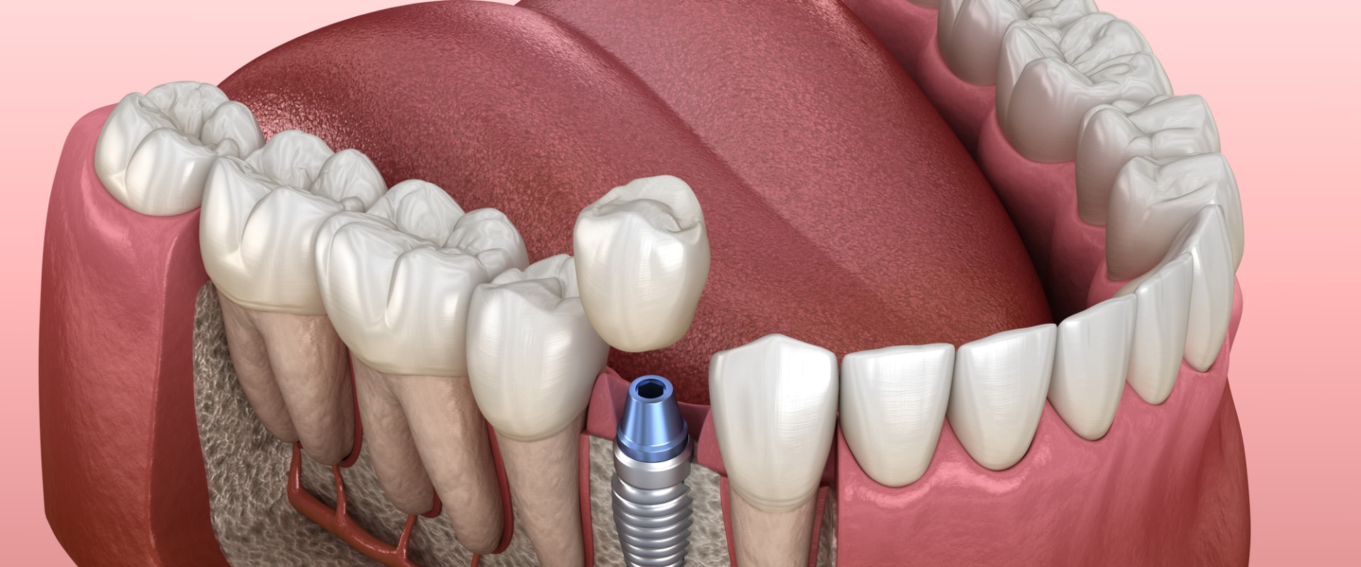 Can You Have Dental Implants with Low Bone Density? - A Comprehensive Guide