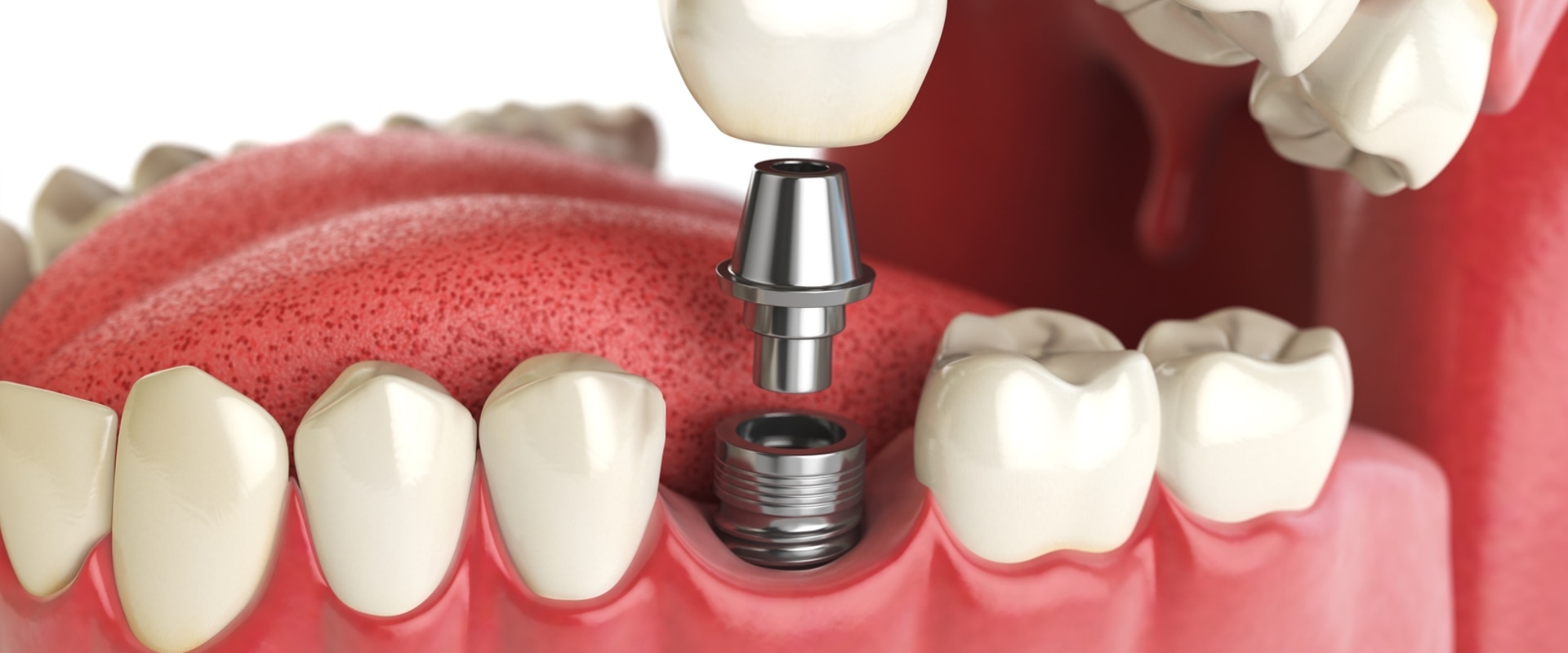 Can I Get a Dental Implant After Radiation Therapy to My Jaw?