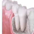 Recovery Time for Dental Implants: What You Need to Know