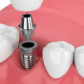 How Long Do Teeth Implants Last? An Expert's Guide to Longevity