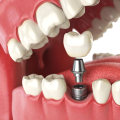 Medications to Avoid After Getting a Dental Implant: An Expert's Guide