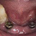 Do I Need an Oral Surgeon or a General Dentist for My Dental Implant?