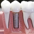What is the Cost of Dental Implants? A Comprehensive Guide