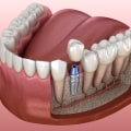 What is the Best Option for Patients with Insufficient Bone Mass to Support a Dental Implant?