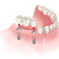 How Often Should You Get Your Dental Implants Checked? A Guide for Patients