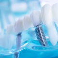 Caring for Dental Implants: A Comprehensive Guide