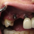 5 Things You Should Not Do After Dental Implants Surgery
