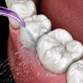 How to Keep Your Teeth Implants Clean and Healthy: A Guide for Oral Hygiene