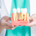 Everything You Need to Know About Dental Implants