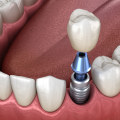 Do I Need to Take Time Off Work After Dental Implant Surgery?