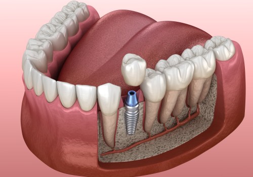 Do I Need Good Jawbone Density for Dental Implants?