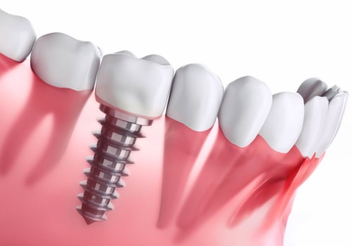 What is Stage 2 of a Dental Implant Procedure? - An Expert's Guide