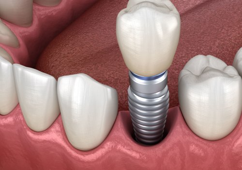 The Pros and Cons of Dental Bridges and Implants: What You Need to Know