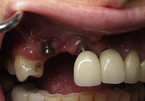 Do Dental Implants Ever Fail? An Expert's Guide