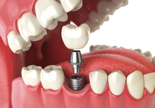 Medications to Avoid After Getting a Dental Implant: An Expert's Guide