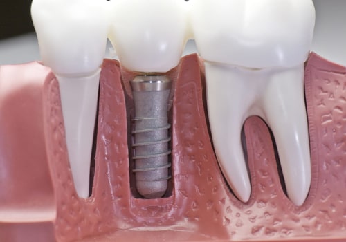 What is the Cost of Dental Implants? A Comprehensive Guide