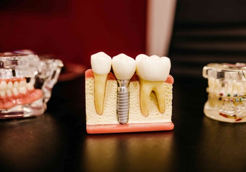 What are the Risks of Dental Implants?
