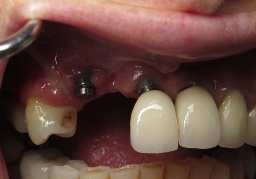 What to Know After Dental Implant Surgery