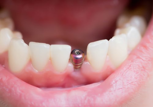 What's the Next Step After a Dental Implant is Placed? - A Comprehensive Guide