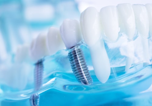 Caring for Teeth with Dental Implants: Special Cleaning Techniques for Optimal Results