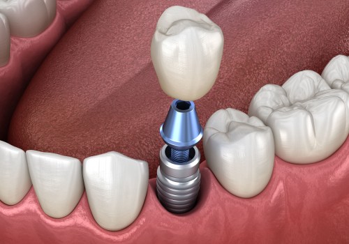 Do I Need to Take Time Off Work After Dental Implant Surgery?