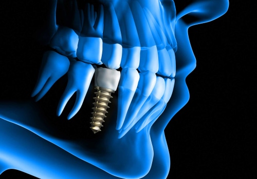 How Much Does it Cost to Get Dental Implants in Alabama?