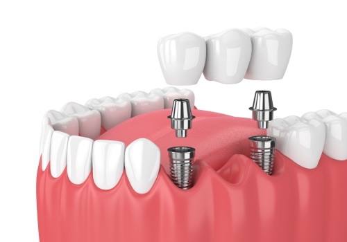 What is the Process of Getting Dental Implants?