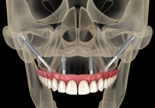 Can I Get a Dental Implant After a Sinus Lift Procedure?